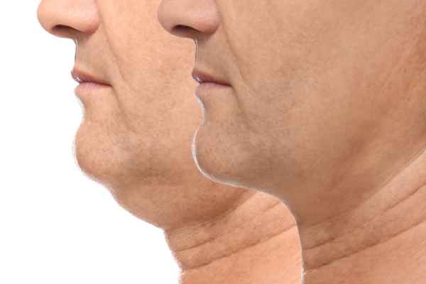 HIFU - Breakthrough in Anti - ageing 2 hifu results Canvey Island