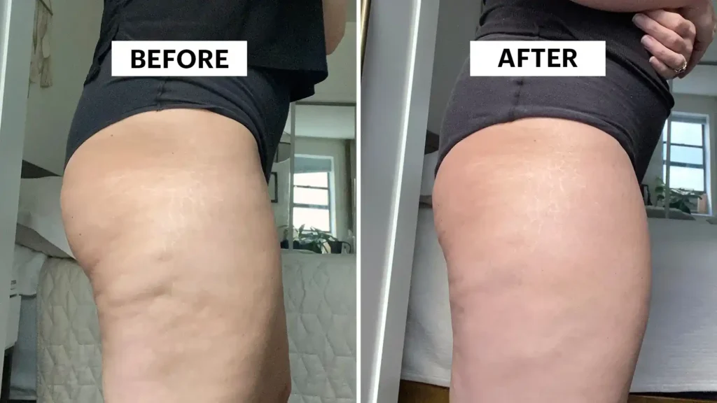 Do Toning Exercise Canvey Island Really Tackle Cellulite?