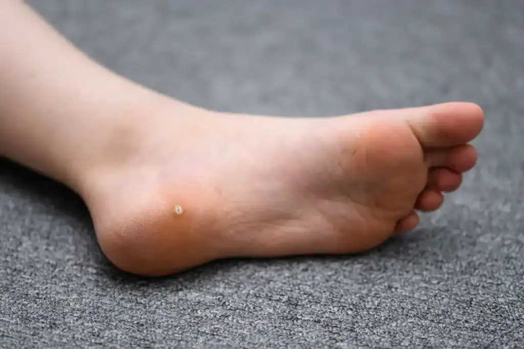 Cryotherapy For Warts And Also Verrucas 2 Image of verruca on the bottom of the foot that able to be treated with Cryotherapy Canvey Island