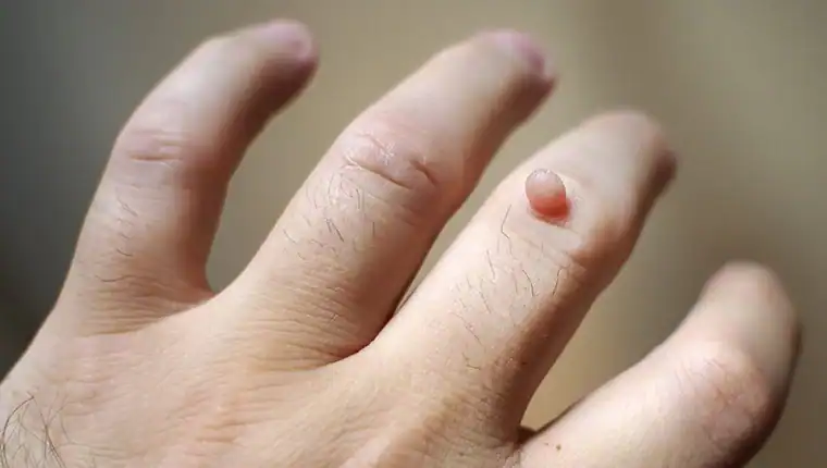 Cryotherapy For Warts And Also Verrucas 1 Image of blemish that Cryotherapy Canvey Island can remove with Lipo 360.