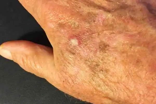 Image of Actinic keratoses Canvey Island on a person hand