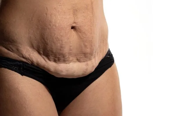 The Science of Skin Tightening 1 The science behind skin tightening Canvey Island picture of a woman's sagging skin on the stomach